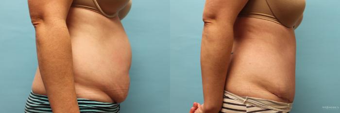 Before & After Tummy Tuck Case 73 View #5 View in St. Louis, MO