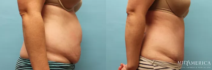 Tummy Tuck Before and After Pictures Case 73