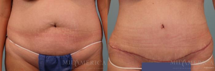 Before & After Tummy Tuck Case 79 View #1 View in Glen Carbon, IL