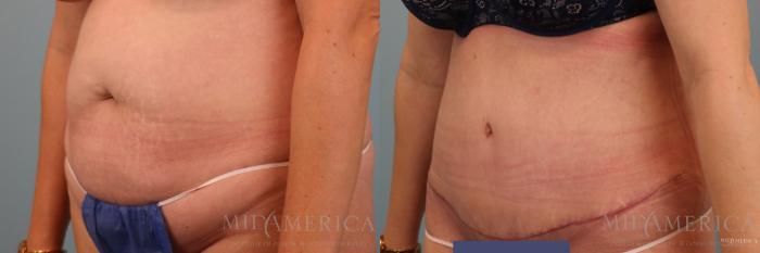 Before & After Tummy Tuck Case 79 View #2 View in Glen Carbon, IL