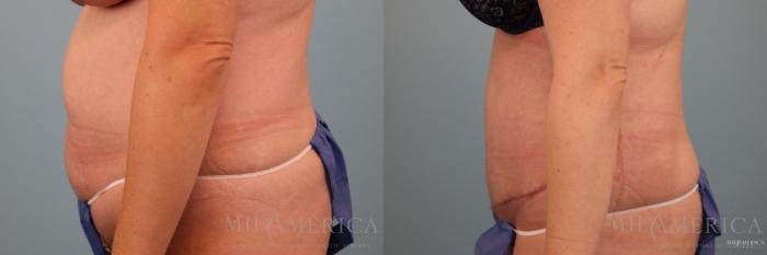 Before & After Tummy Tuck Case 79 View #3 View in Glen Carbon, IL
