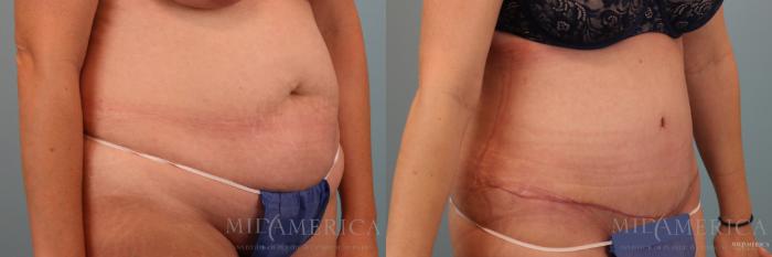 Before & After Tummy Tuck Case 79 View #4 View in Glen Carbon, IL