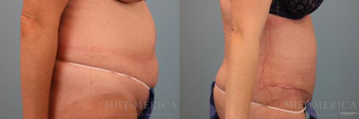Before & After Tummy Tuck Case 79 View #5 View in Glen Carbon, IL