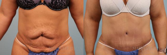 Before & After Tummy Tuck Case 80 View #1 View in Glen Carbon, IL