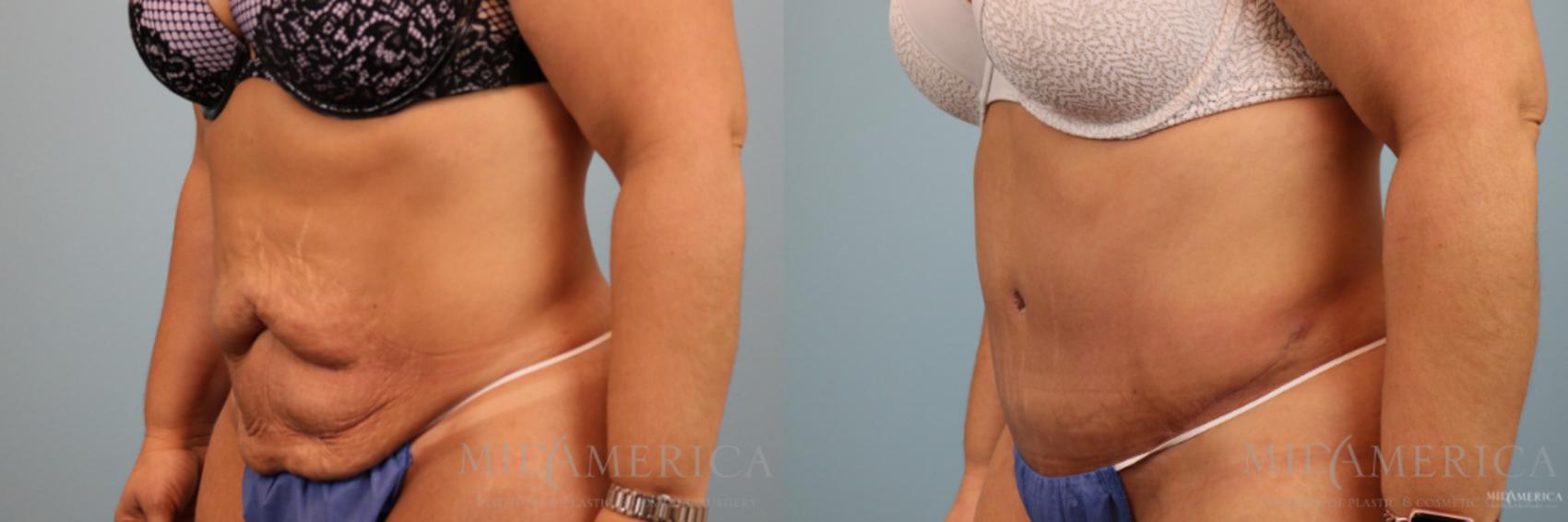 Before & After Tummy Tuck Case 80 View #2 View in Glen Carbon, IL