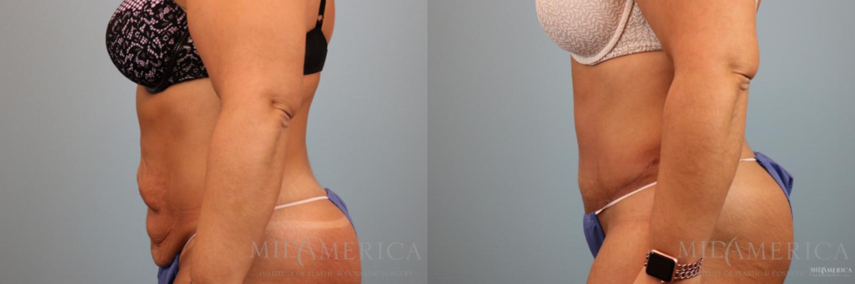 Before & After Tummy Tuck Case 80 View #3 View in Glen Carbon, IL