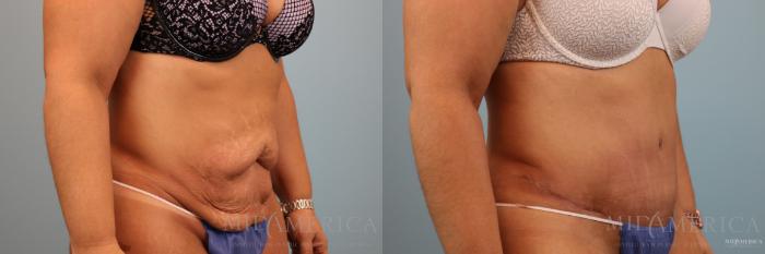 Before & After Tummy Tuck Case 80 View #4 View in St. Louis, MO