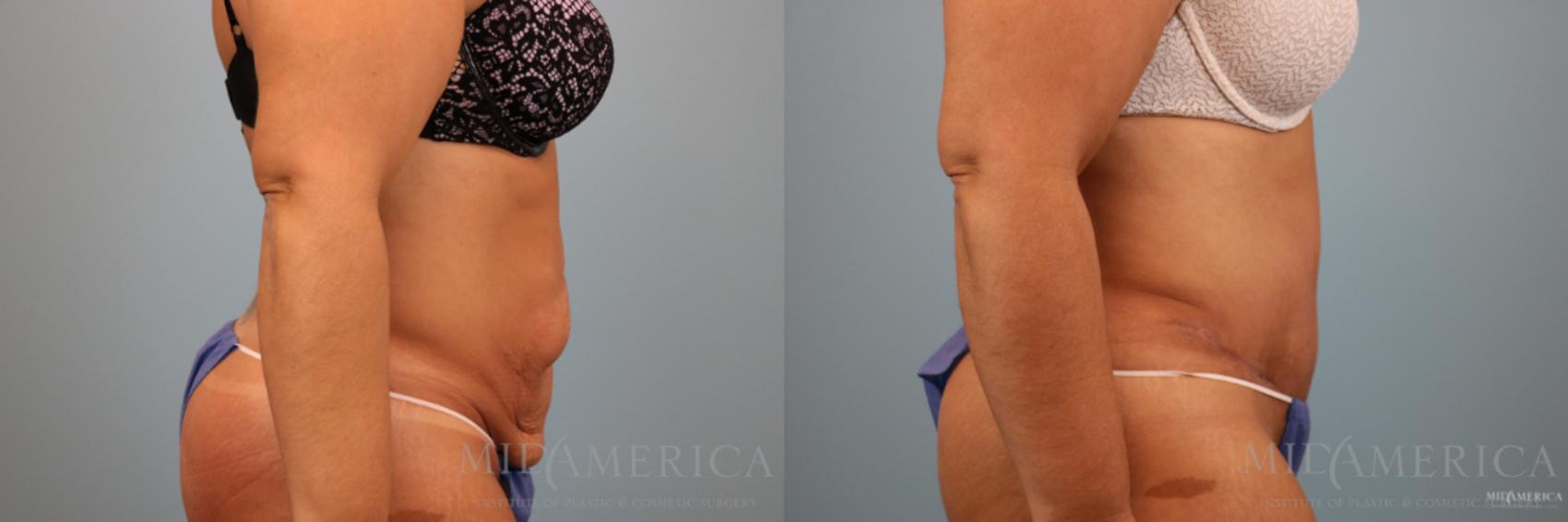 Before & After Tummy Tuck Case 80 View #5 View in Glen Carbon, IL