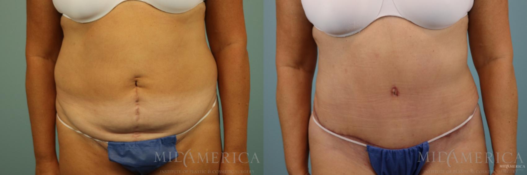 Before & After Tummy Tuck Case 86 View #1 View in Glen Carbon, IL