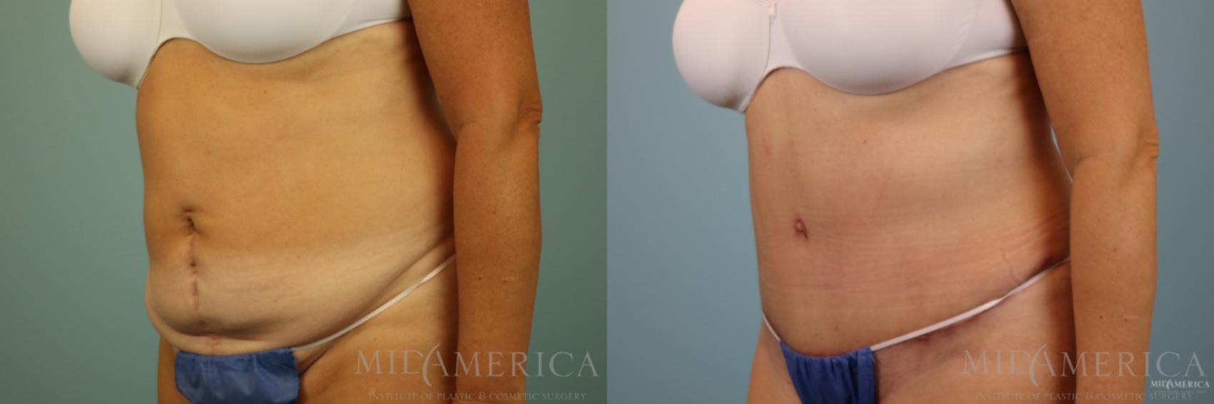 Before & After Tummy Tuck Case 86 View #2 View in Glen Carbon, IL