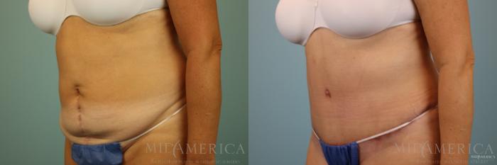 Before & After Tummy Tuck Case 86 View #2 View in St. Louis, MO