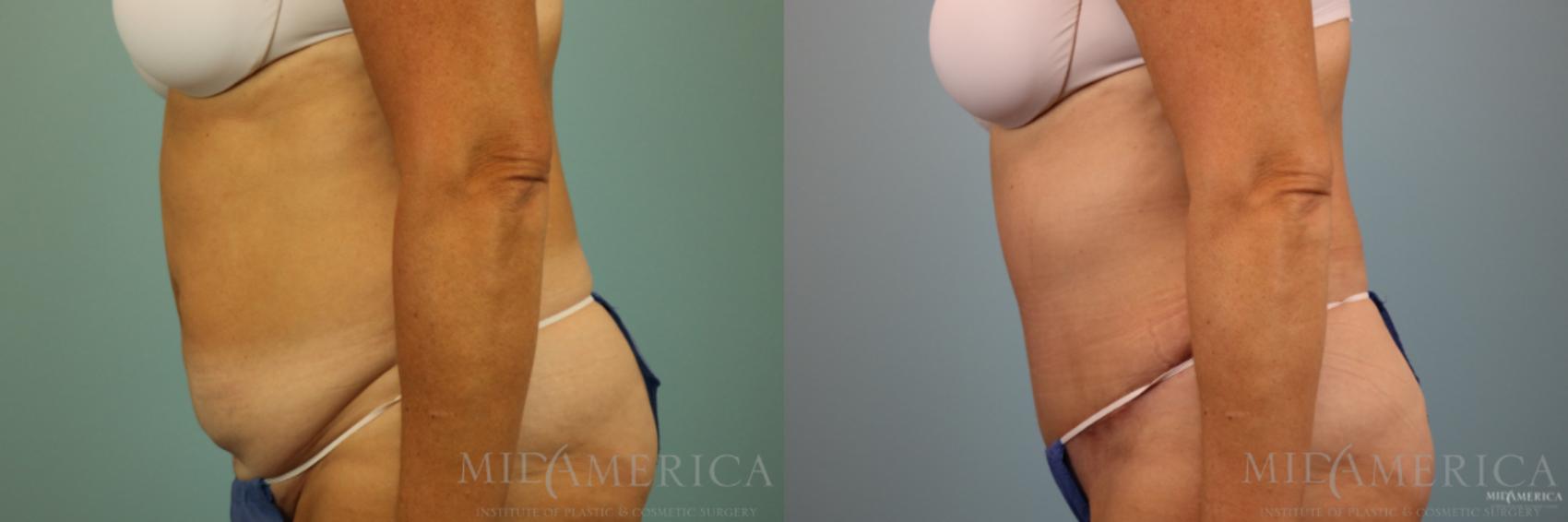 Before & After Tummy Tuck Case 86 View #3 View in Glen Carbon, IL