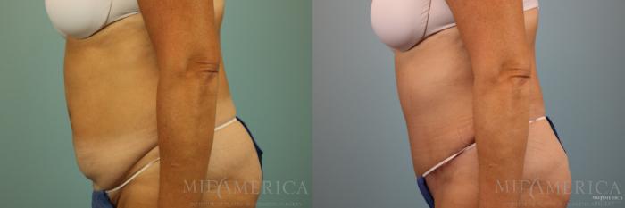 Before & After Tummy Tuck Case 86 View #3 View in St. Louis, MO