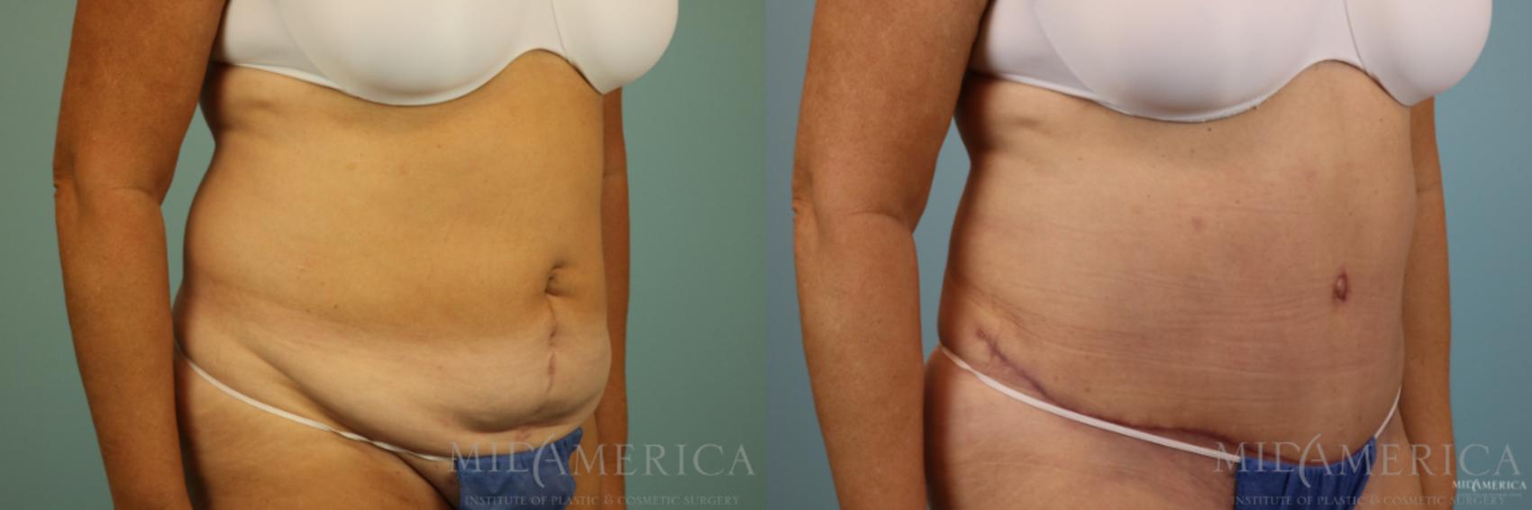 Before & After Tummy Tuck Case 86 View #4 View in Glen Carbon, IL