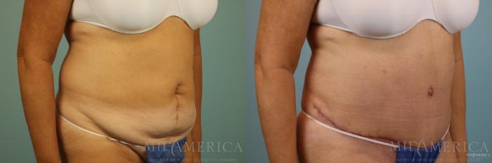 Before & After Tummy Tuck Case 86 View #4 View in St. Louis, MO