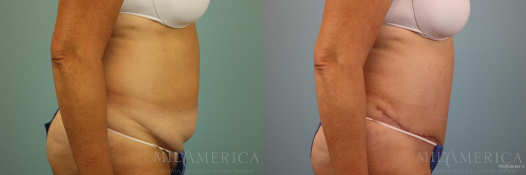 Before & After Tummy Tuck Case 86 View #5 View in Glen Carbon, IL