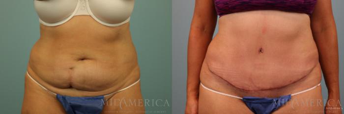 Before & After Tummy Tuck Case 89 View #1 View in Glen Carbon, IL