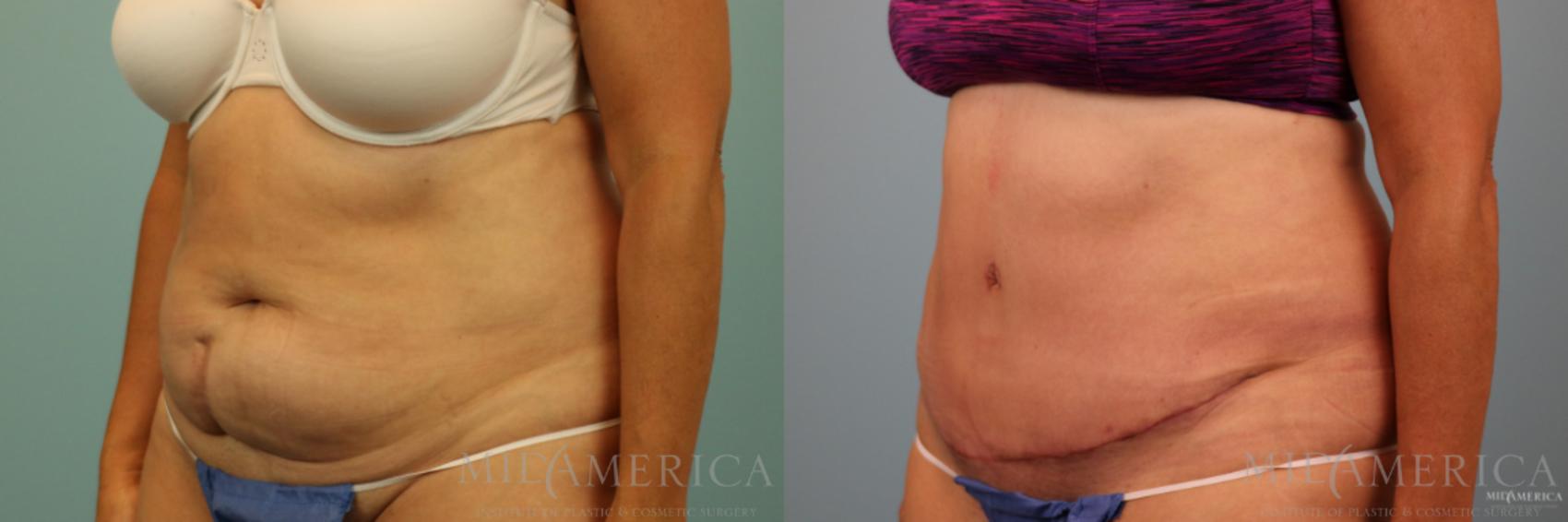 Before & After Tummy Tuck Case 89 View #2 View in Glen Carbon, IL