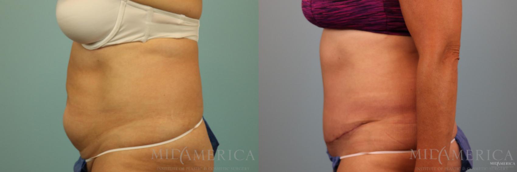 Before & After Tummy Tuck Case 89 View #3 View in Glen Carbon, IL