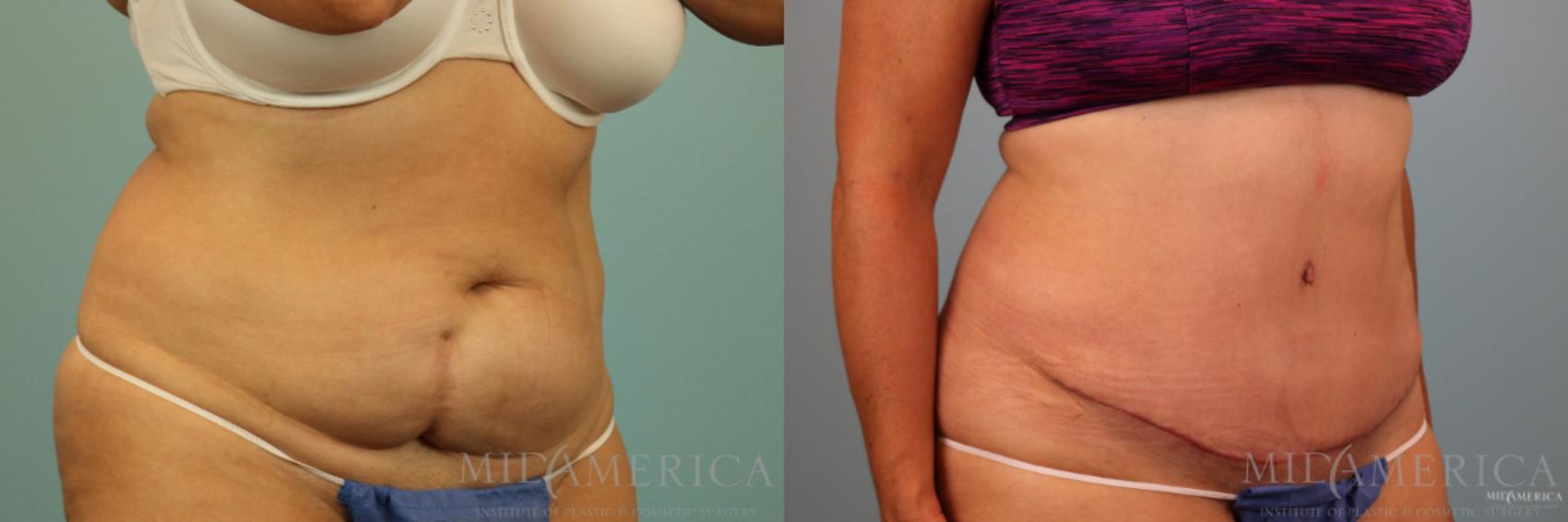 Before & After Tummy Tuck Case 89 View #4 View in Glen Carbon, IL
