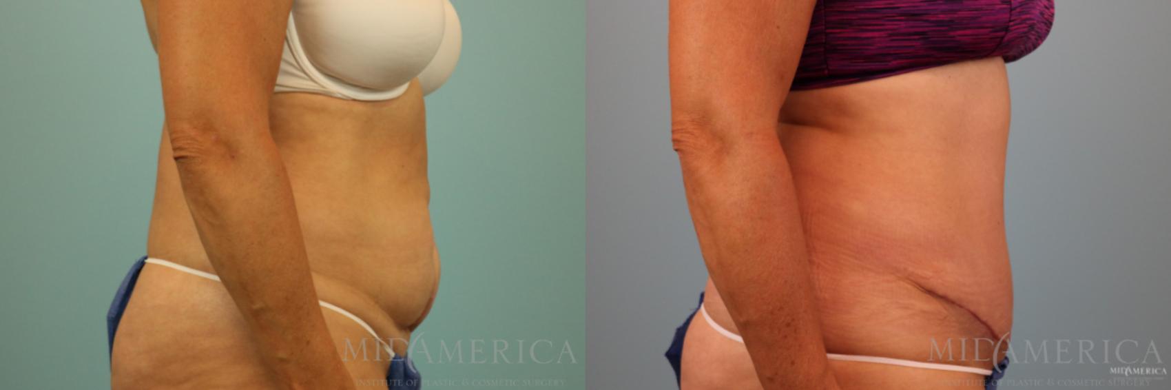 Before & After Tummy Tuck Case 89 View #5 View in Glen Carbon, IL