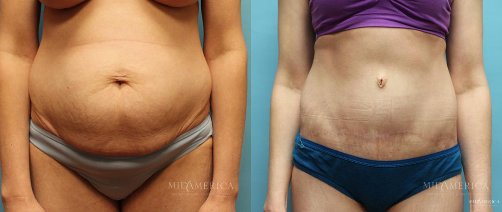 Before & After Tummy Tuck Case 9 View #1 View in Glen Carbon, IL