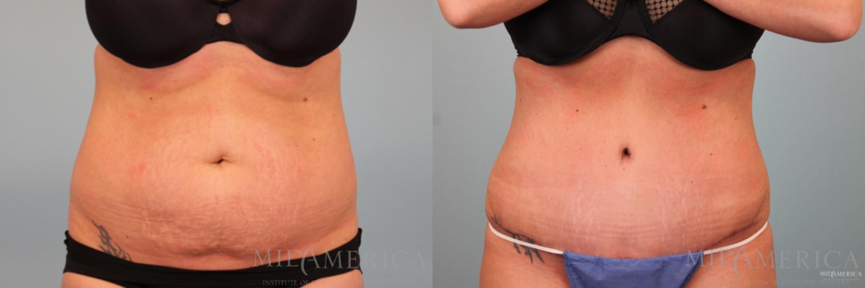 Before & After Tummy Tuck Case 90 View #1 View in Glen Carbon, IL