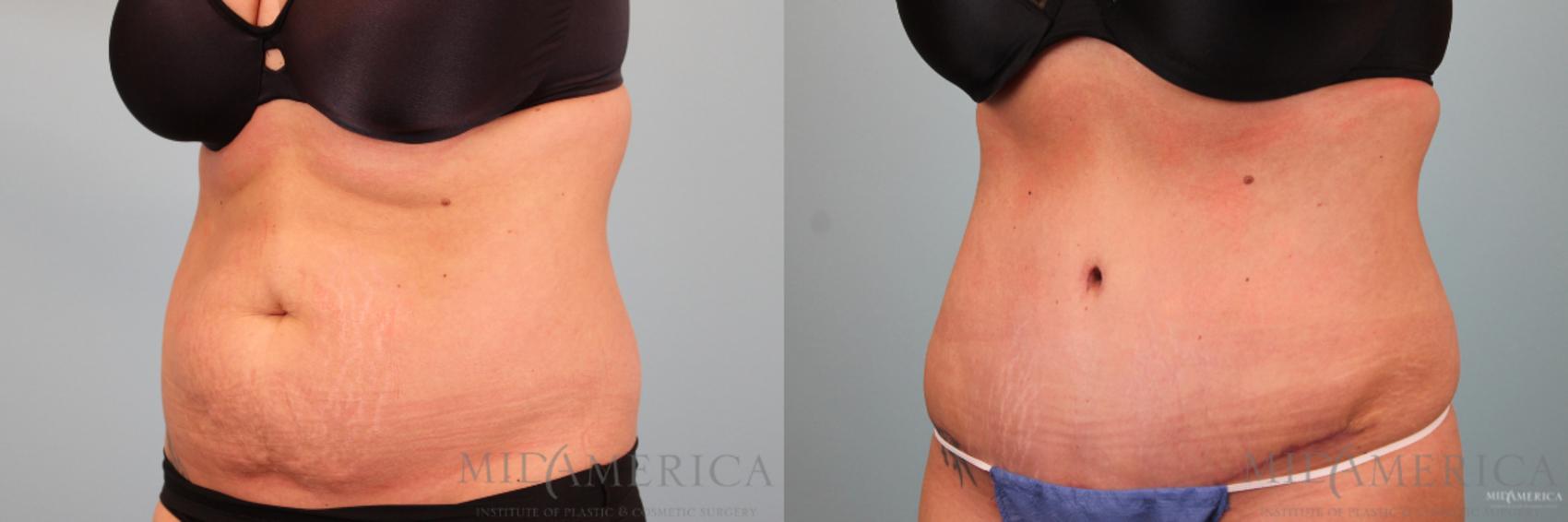 Before & After Tummy Tuck Case 90 View #2 View in Glen Carbon, IL