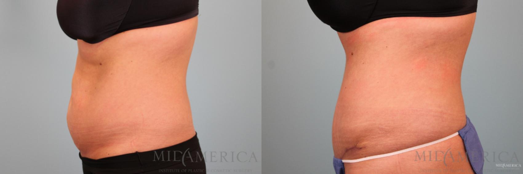 Before & After Tummy Tuck Case 90 View #3 View in Glen Carbon, IL