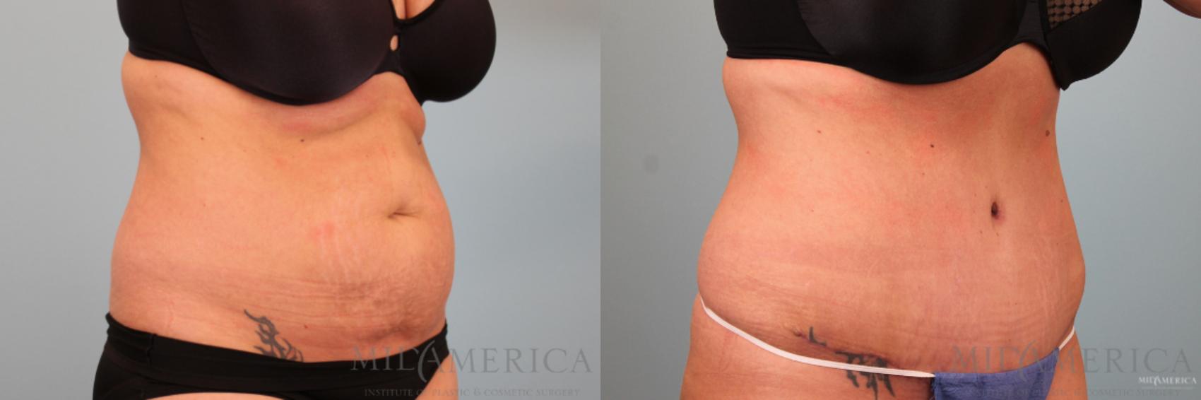 Before & After Tummy Tuck Case 90 View #4 View in Glen Carbon, IL