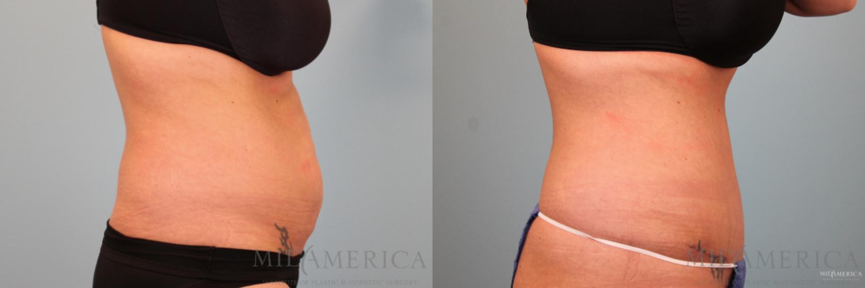 Before & After Tummy Tuck Case 90 View #5 View in Glen Carbon, IL