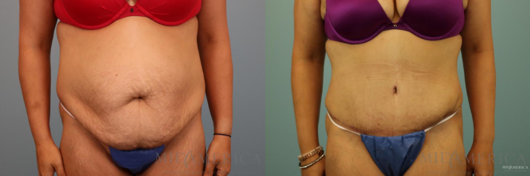 Before & After Tummy Tuck Case 91 View #1 View in Glen Carbon, IL