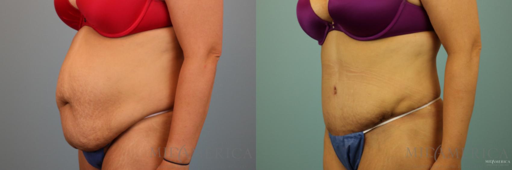 Before & After Tummy Tuck Case 91 View #2 View in Glen Carbon, IL
