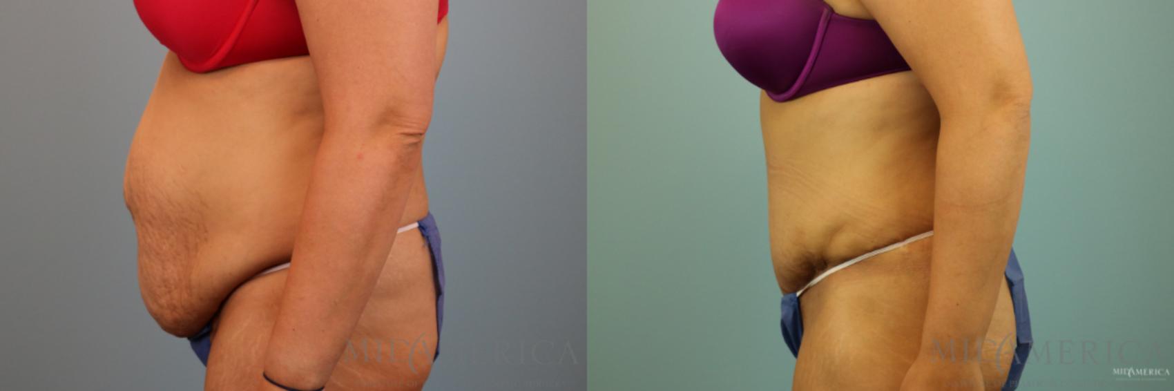 Before & After Tummy Tuck Case 91 View #3 View in Glen Carbon, IL