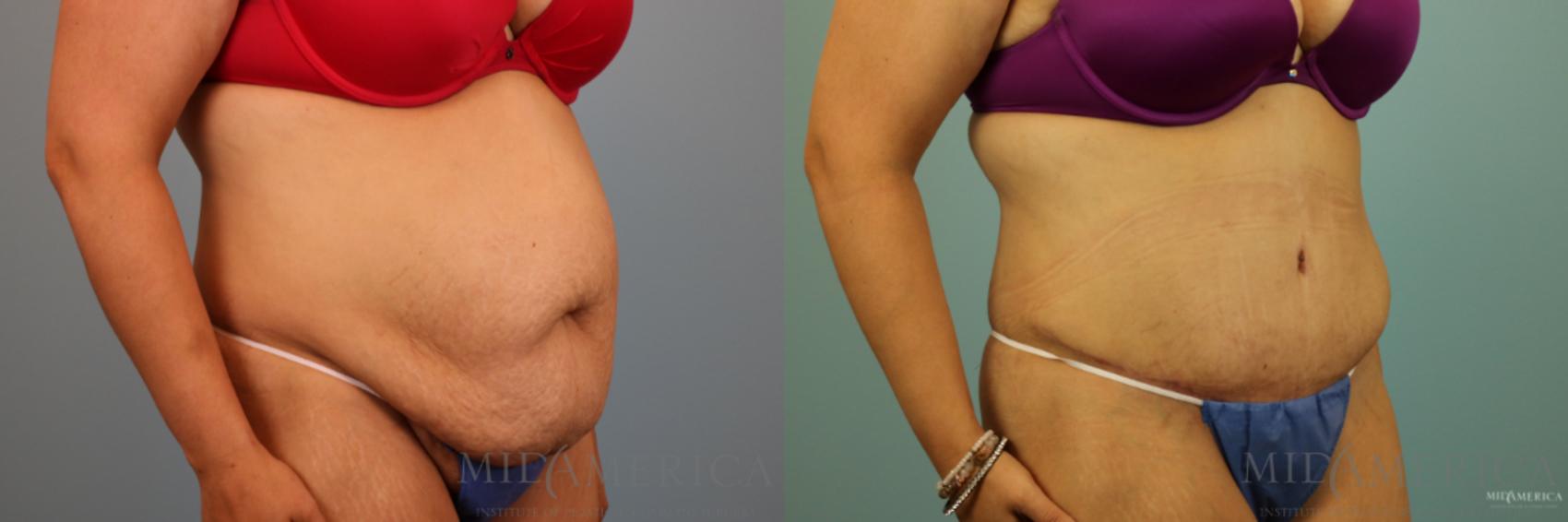 Before & After Tummy Tuck Case 91 View #4 View in Glen Carbon, IL