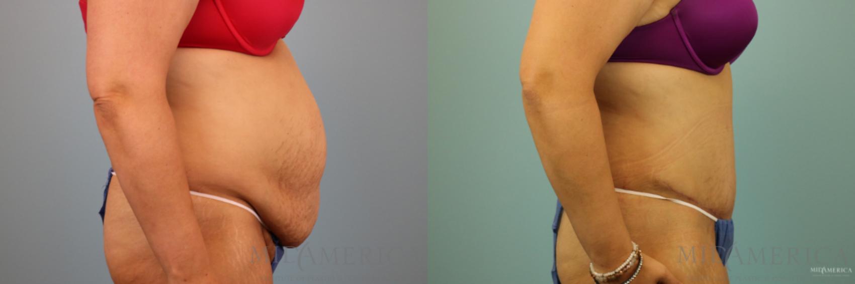 Before & After Tummy Tuck Case 91 View #5 View in Glen Carbon, IL